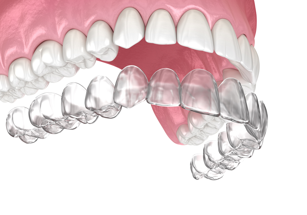 Ortodonta bielsko leczenie nakładkami